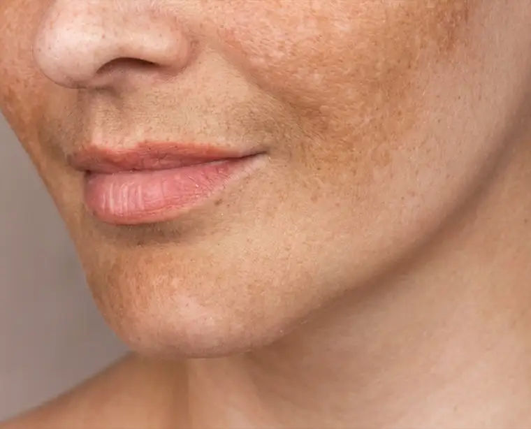 Tratamento de melasma na VOSS Dermatologia