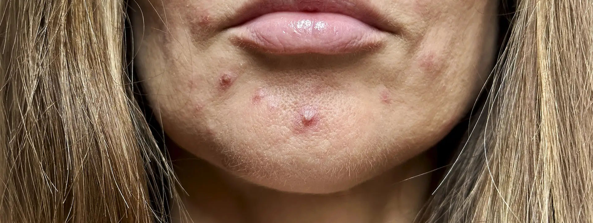 Acne da Mulher Adulta — Dermatologia Clínica VOSS Dermatologia