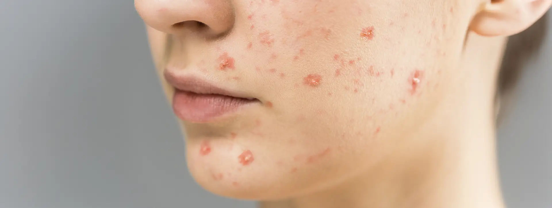 Molusco Contagioso — Dermatologia Clínica VOSS Dermatologia