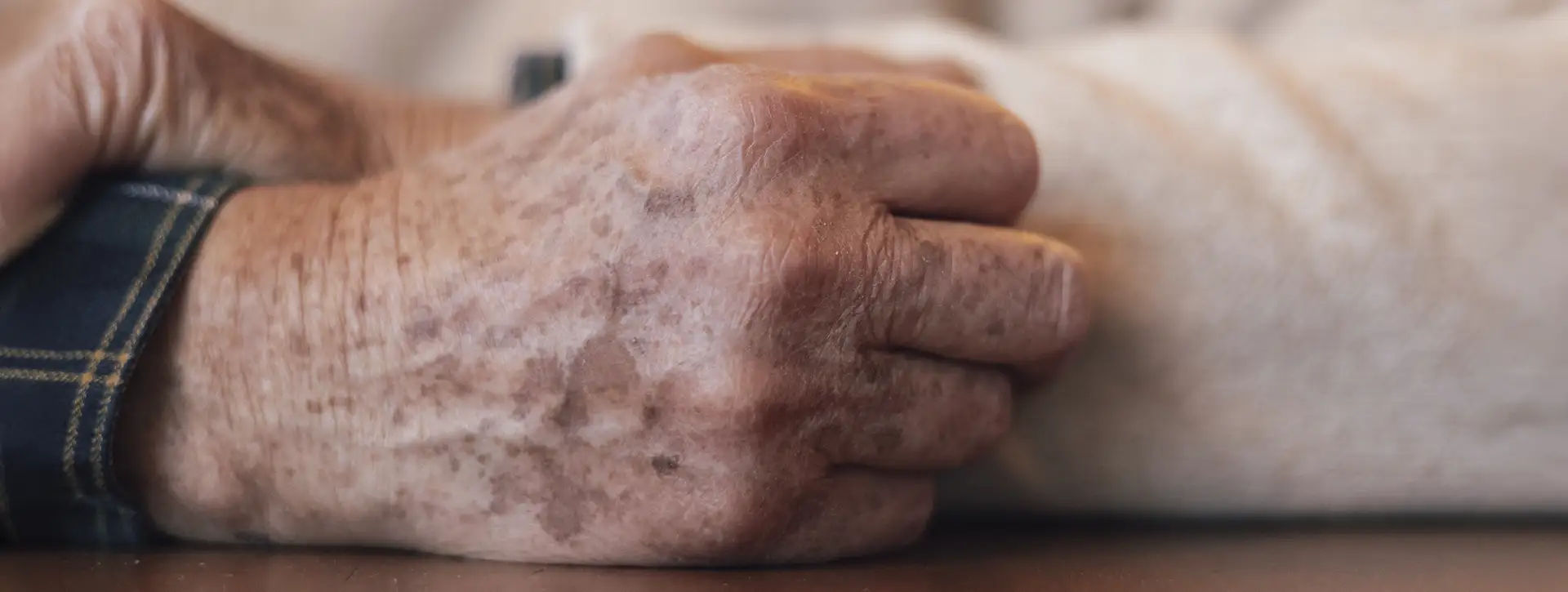 Melanose Solar (Mancha Senil) — Dermatologia Clínica VOSS Dermatologia
