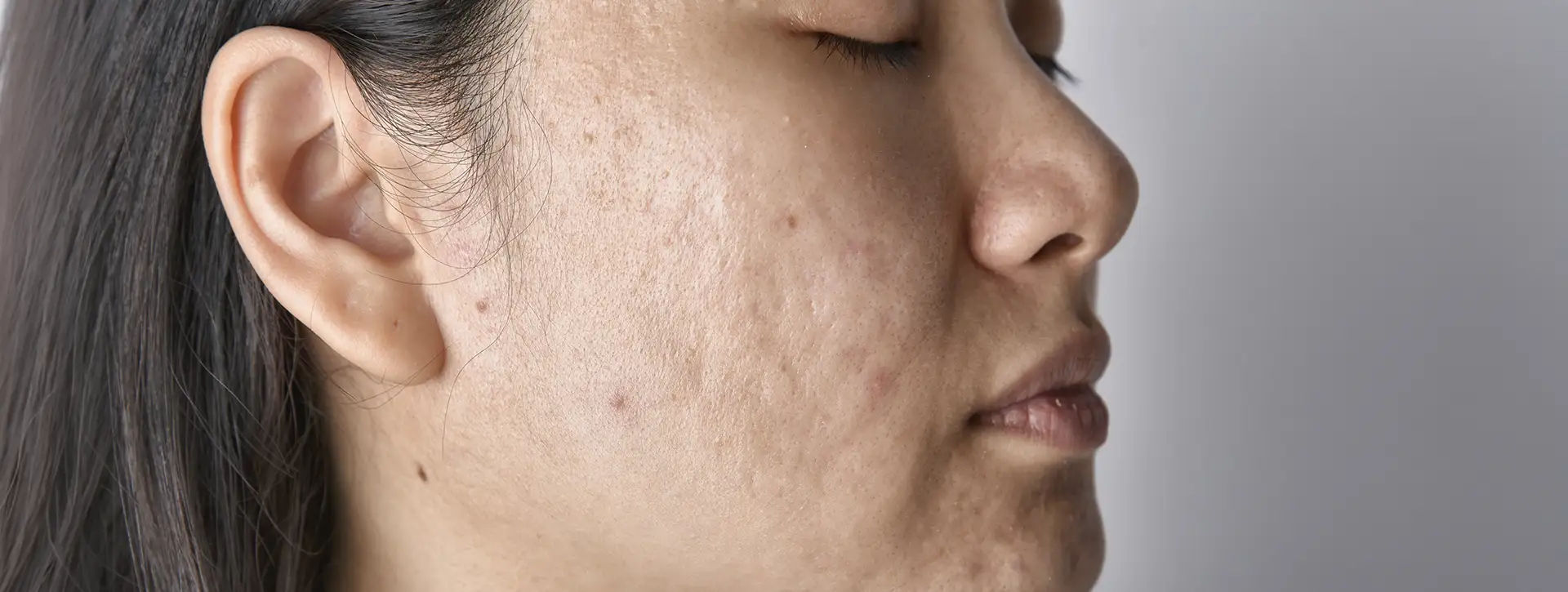 Cicatrizes de Acne — Dermatologia Estética VOSS Dermatologia