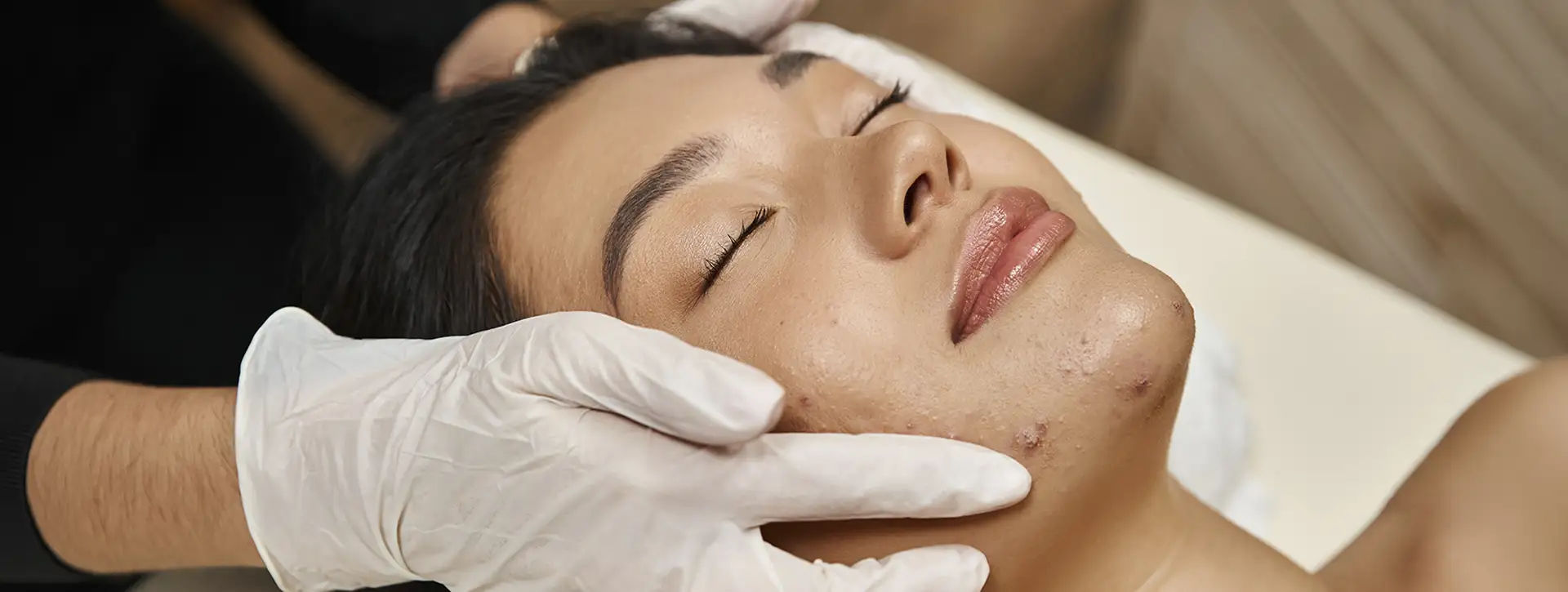 Tipos de Peeling para Marcas de Acne — Dermatologia Estética VOSS Dermatologia