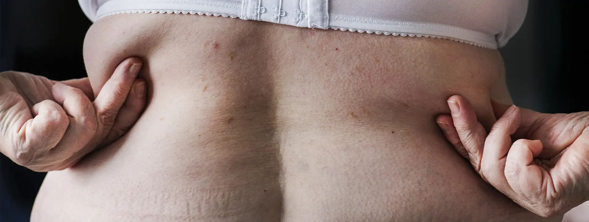 Gordura Localizada — Dermatologia Estética VOSS Dermatologia