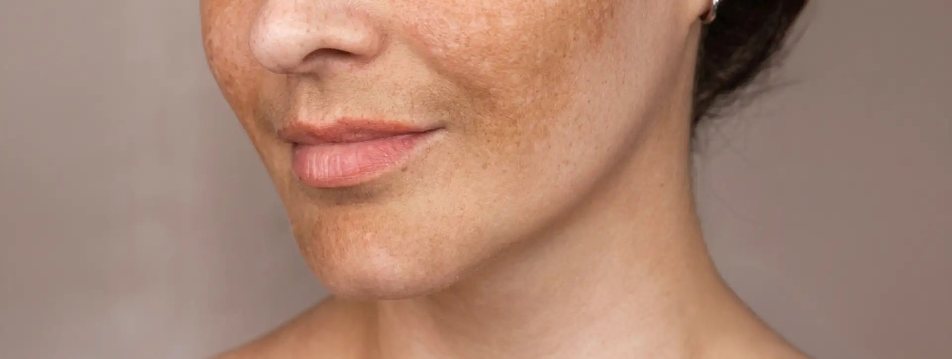 Melasma — Dermatologia Clínica VOSS Dermatologia