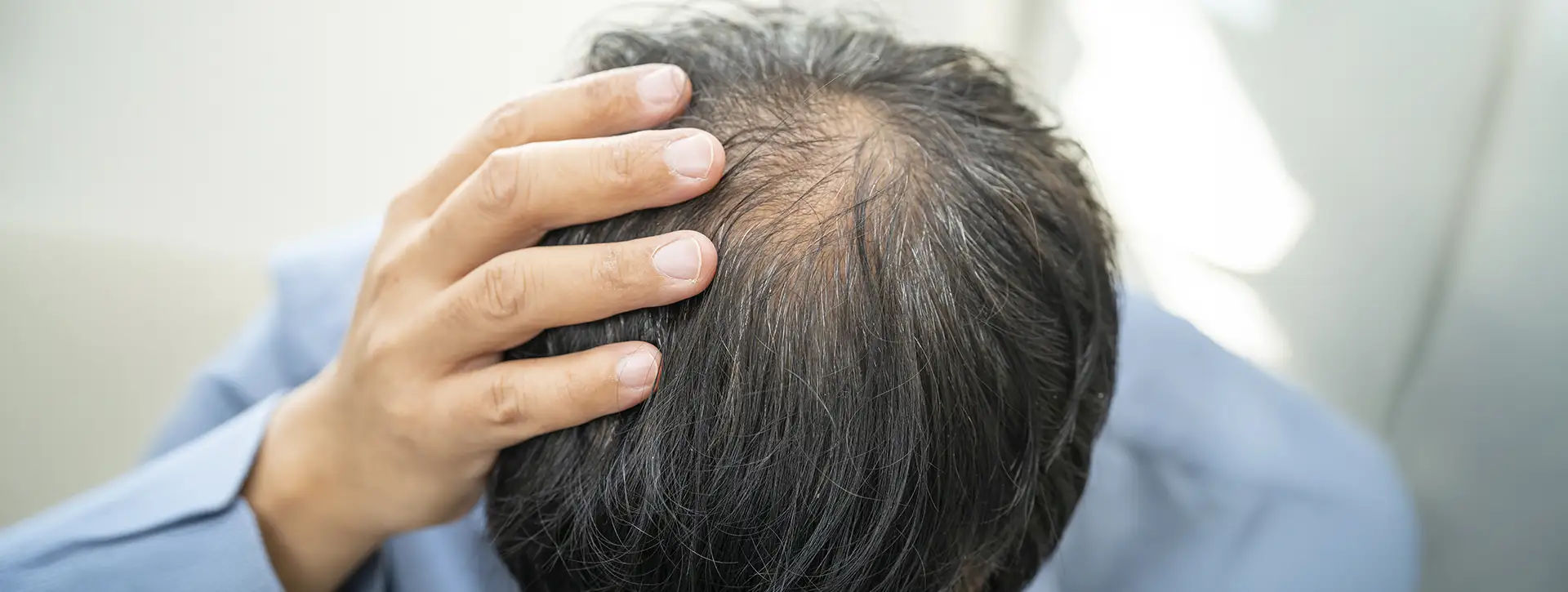 Calvície — Dermatologia Capilar VOSS Dermatologia