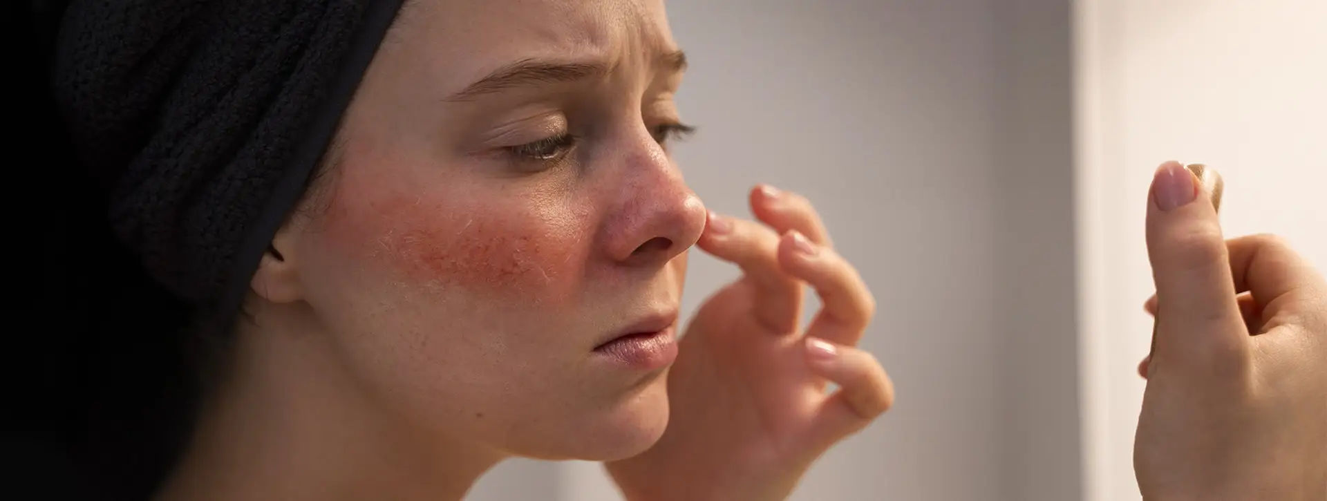 Rosácea — Dermatologia Clínica VOSS Dermatologia