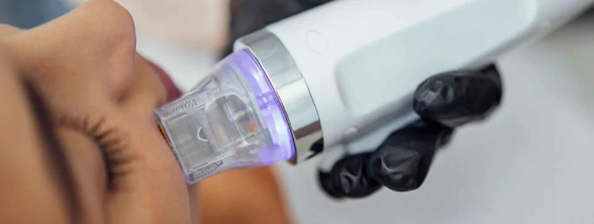 Radiofrequência 3DEEP (EndyMed) — Tecnologias e Inovações VOSS Dermatologia