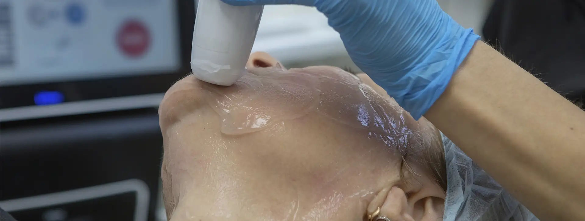 Ultrassom Micro e Macrofocado (Ultraformer MPT) — Tecnologias e Inovações VOSS Dermatologia