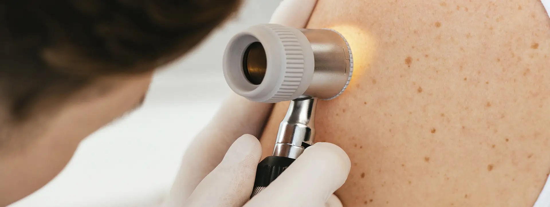 Câncer de Pele — Dermatologia Clínica VOSS Dermatologia
