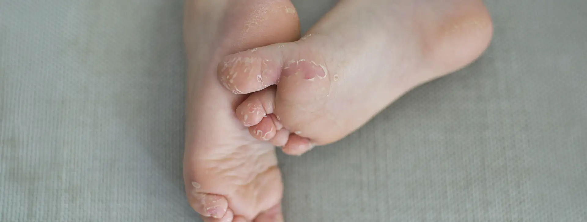 Micose — Dermatologia Clínica VOSS Dermatologia